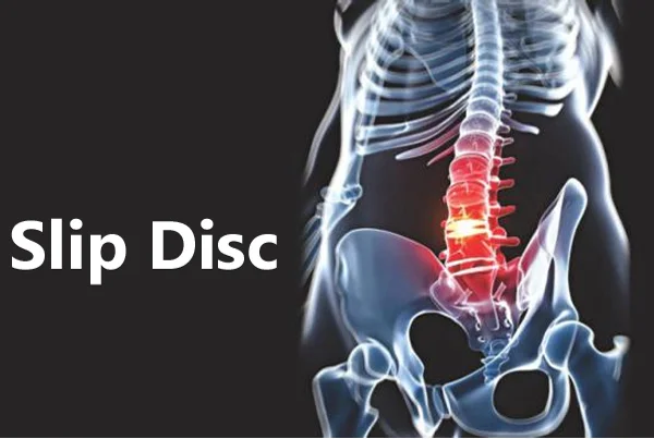 Slip Disc Treatment