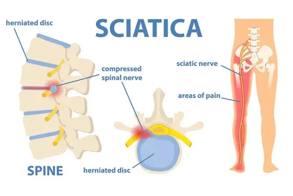 Sciatica Pain